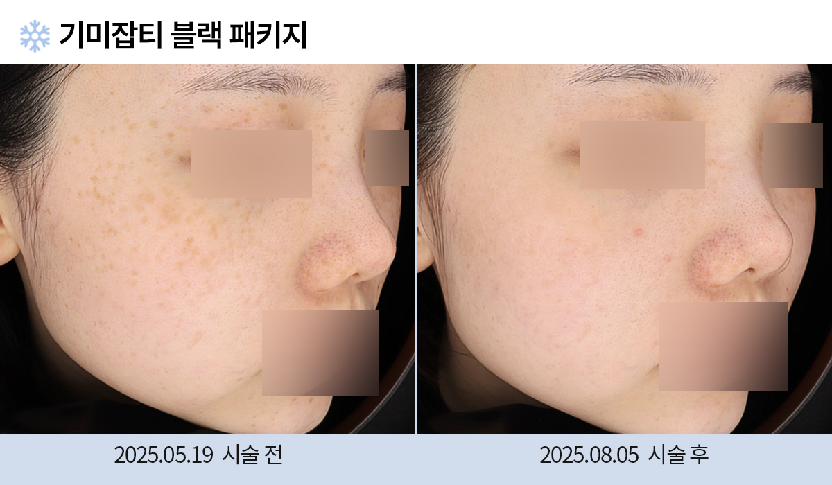 기미/주근깨/흑자 이미지