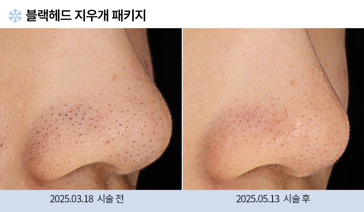 기미/주근깨/흑자 이미지