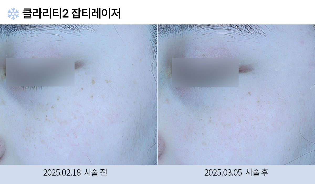 기미/주근깨/흑자 이미지