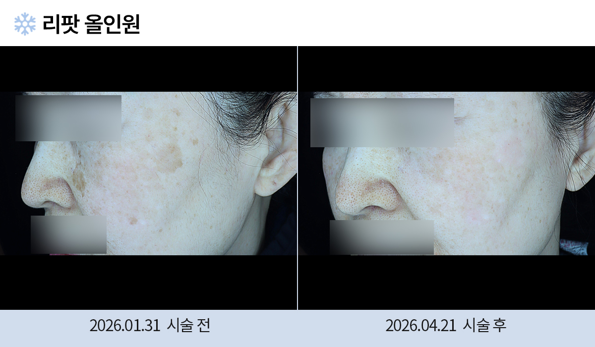 기미/주근깨/흑자 이미지