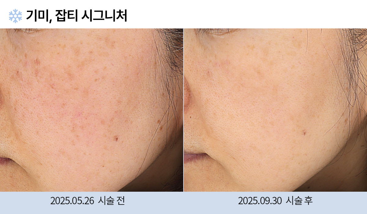 기미/주근깨/흑자 이미지