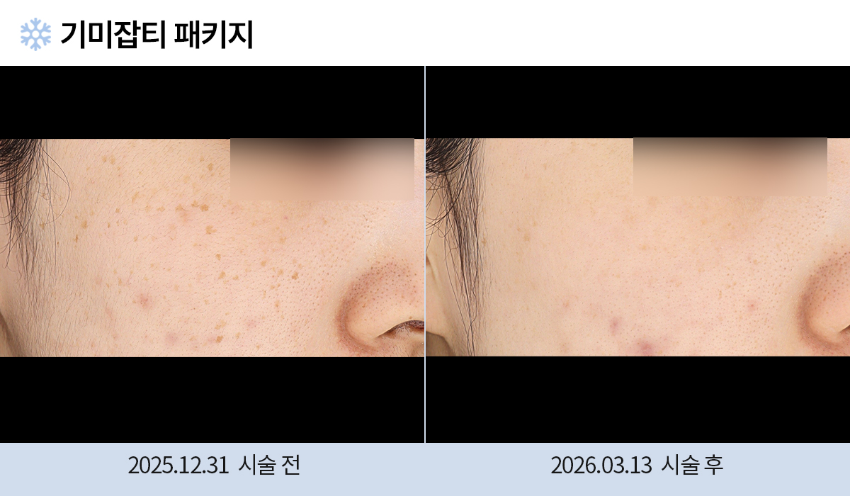 기미/주근깨/흑자 이미지