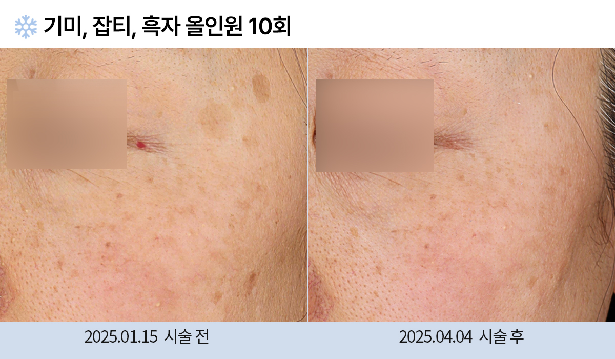 기미/주근깨/흑자 이미지