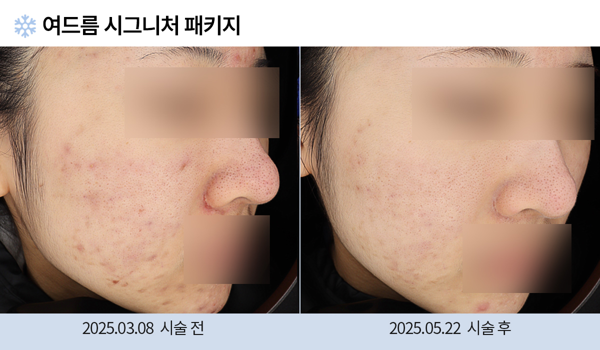 여드름/붉은자국/홍조 이미지