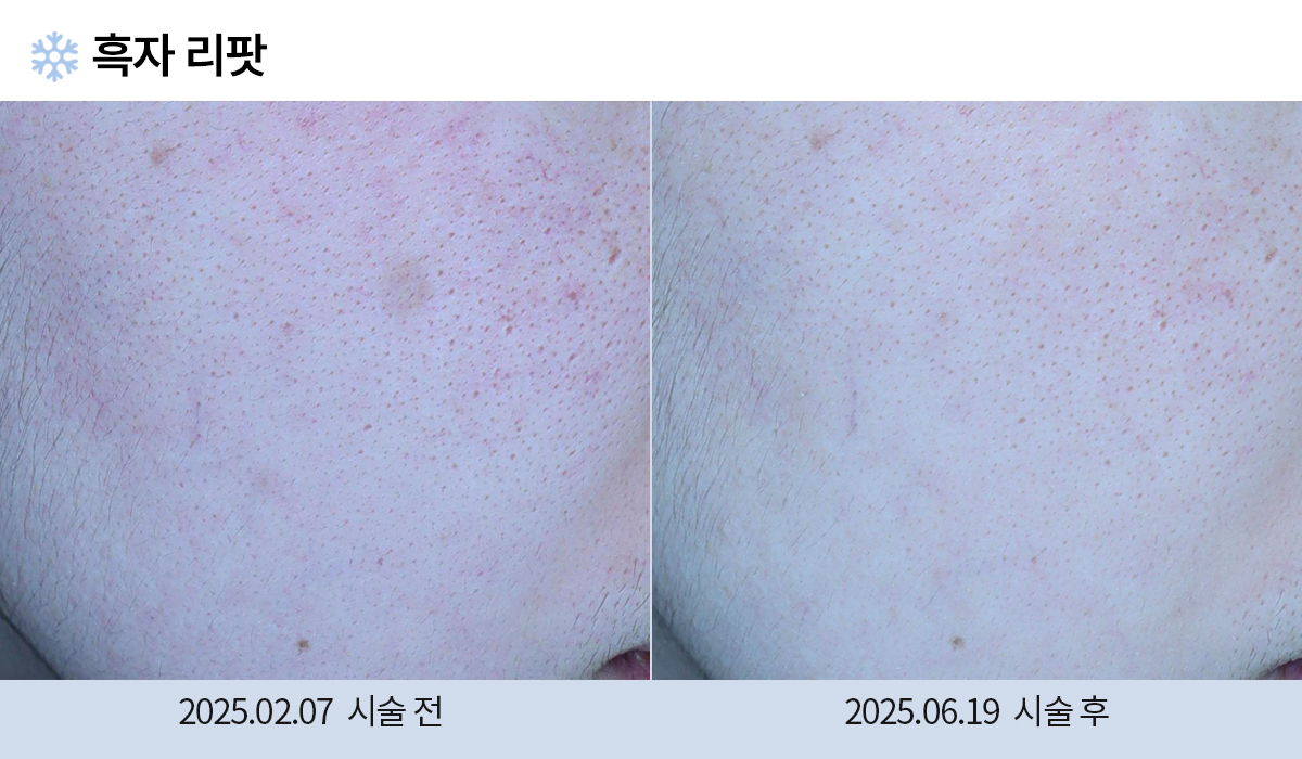 기미/주근깨/흑자 이미지