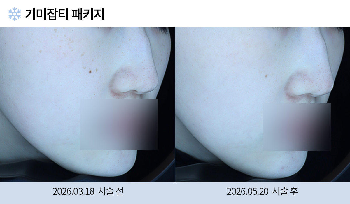 기미/주근깨/흑자 이미지
