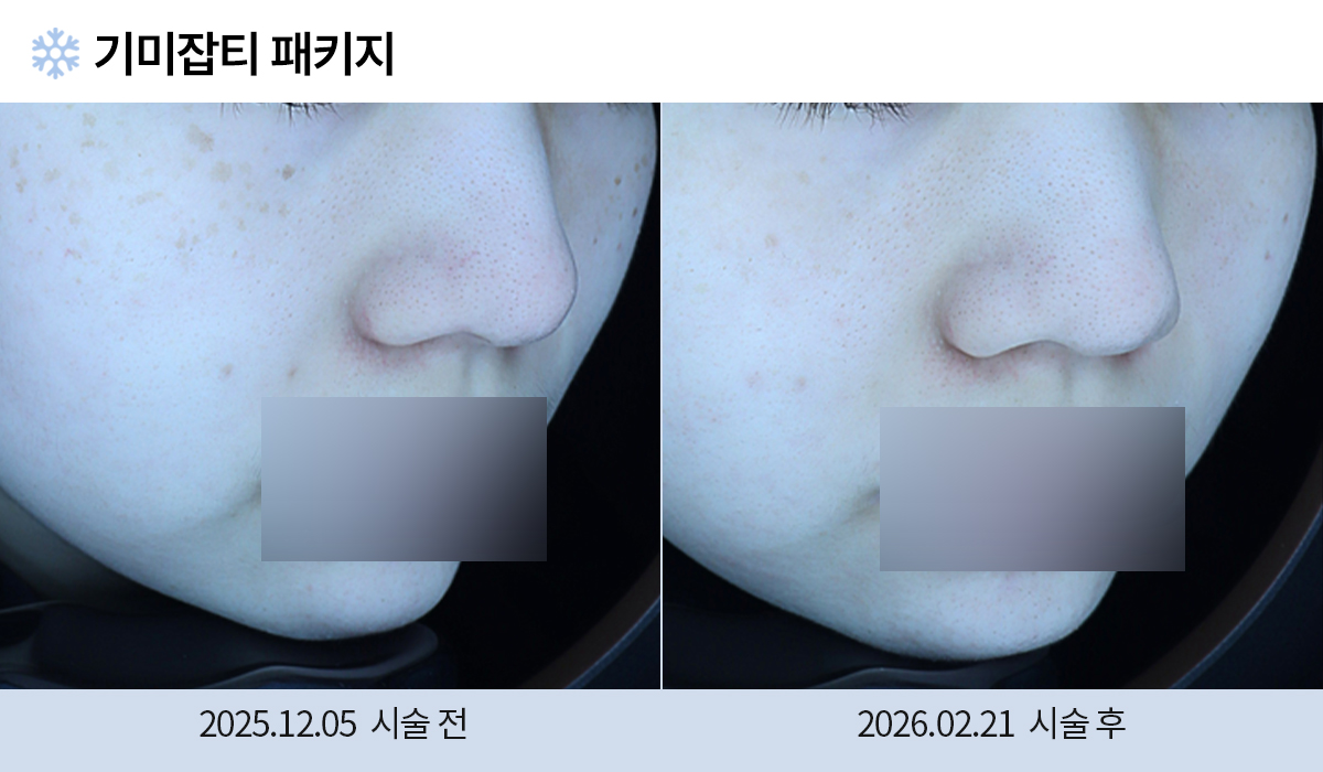 기미/주근깨/흑자 이미지