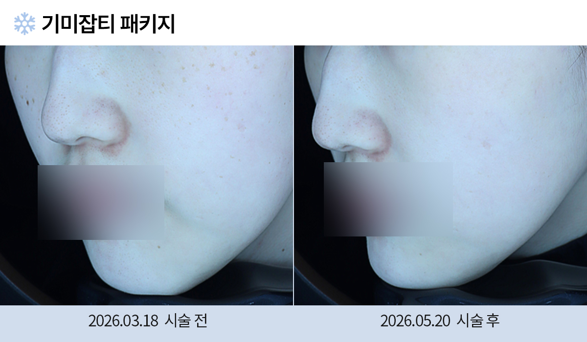 기미/주근깨/흑자 이미지