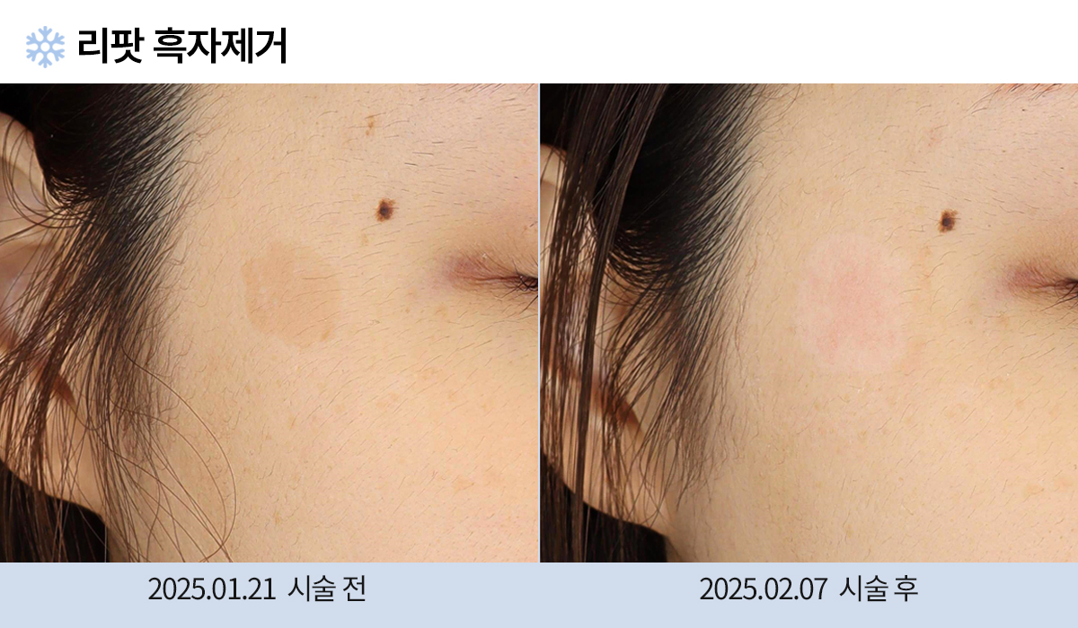 기미/주근깨/흑자 이미지