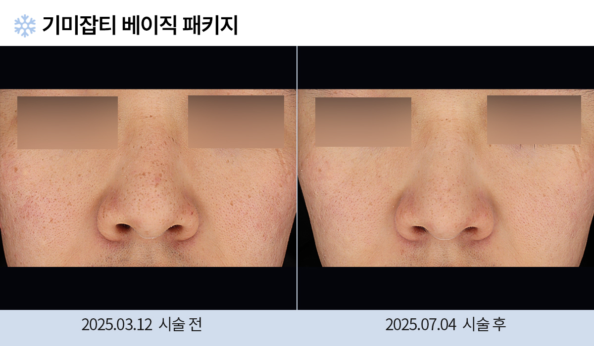 기미/주근깨/흑자 이미지