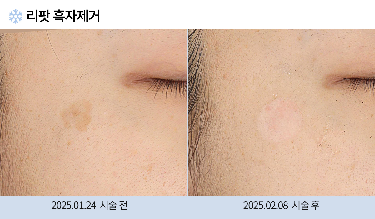 기미/주근깨/흑자 이미지