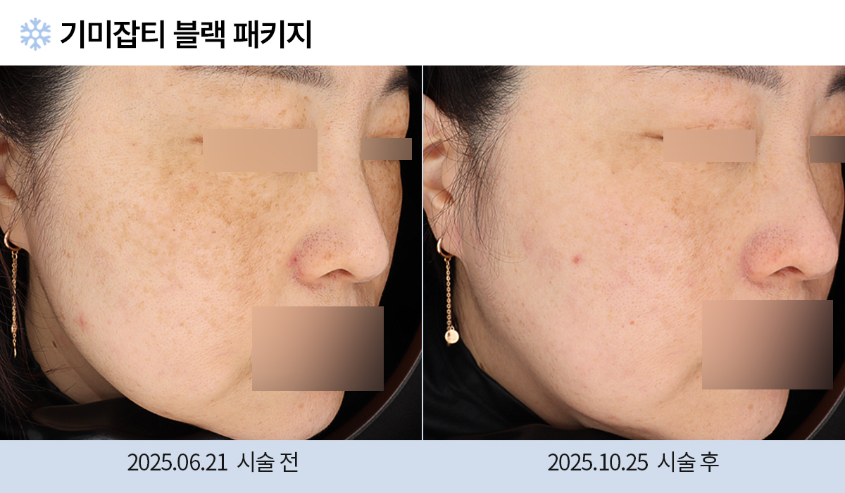 기미/주근깨/흑자 이미지