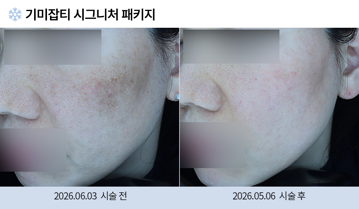 기미/주근깨/흑자 이미지