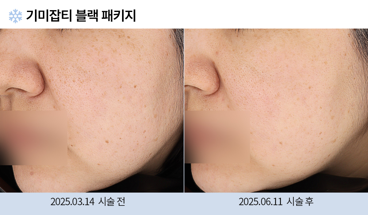 기미/주근깨/흑자 이미지