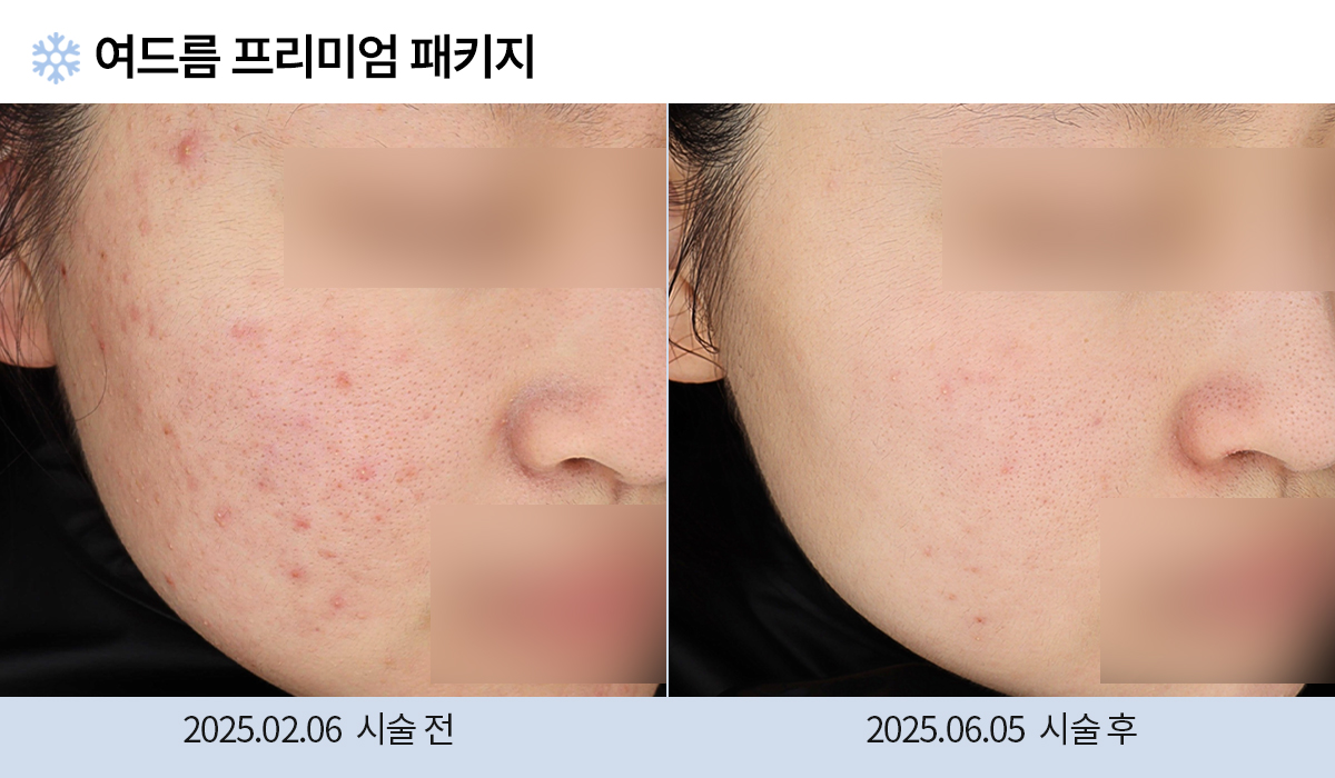 여드름/붉은자국/홍조 이미지