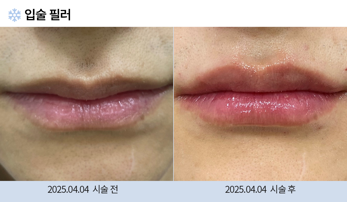 필러/보톡스 시술 전후 작업 이미지