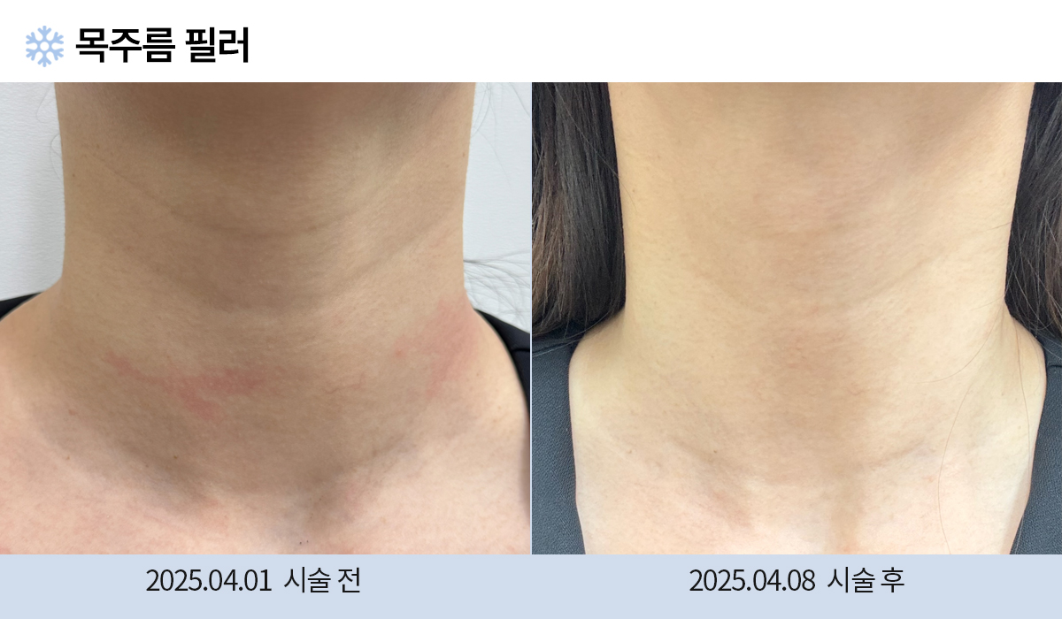 필러/보톡스 시술 전후 작업 이미지