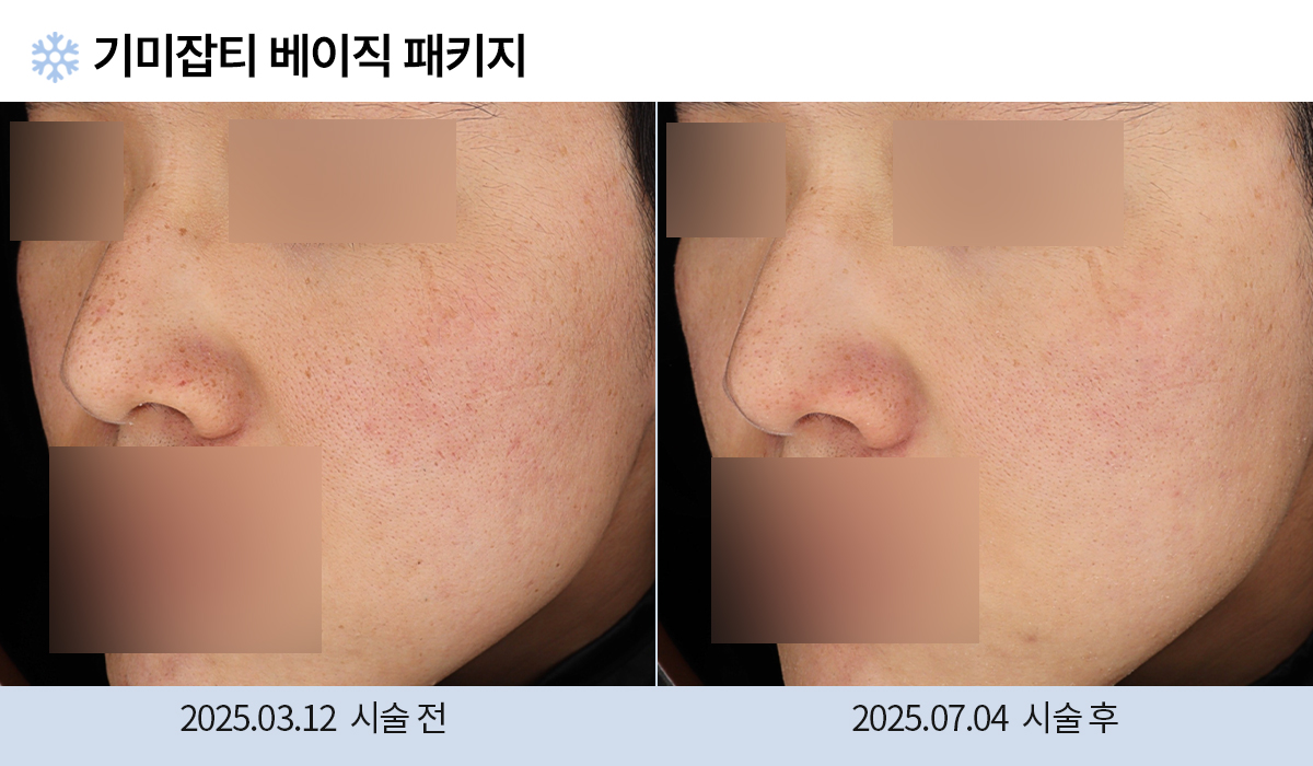 기미/주근깨/흑자 이미지