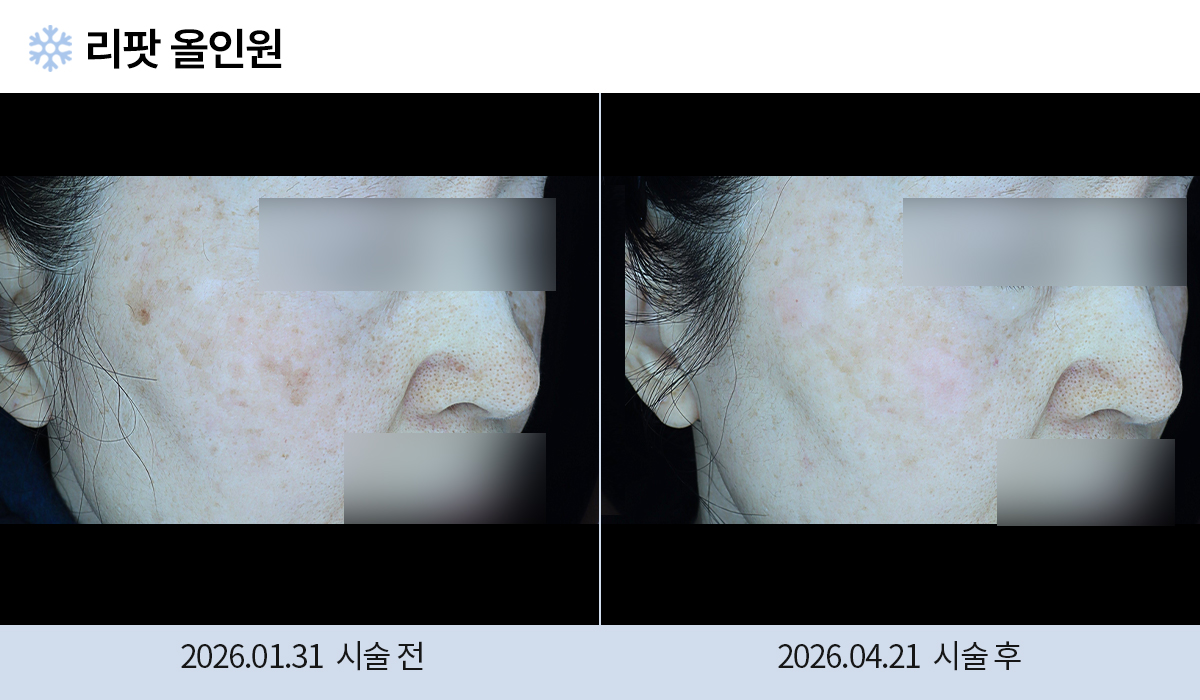 기미/주근깨/흑자 이미지