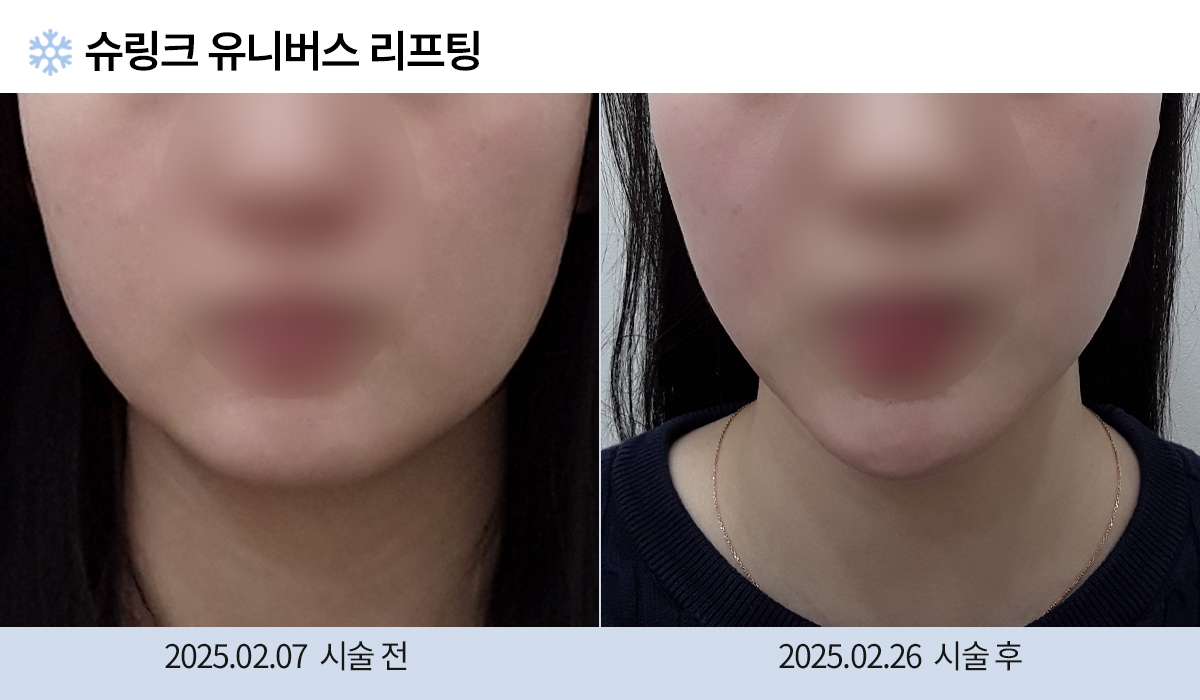 리프팅/피부탄력개선 전후 작업 이미지