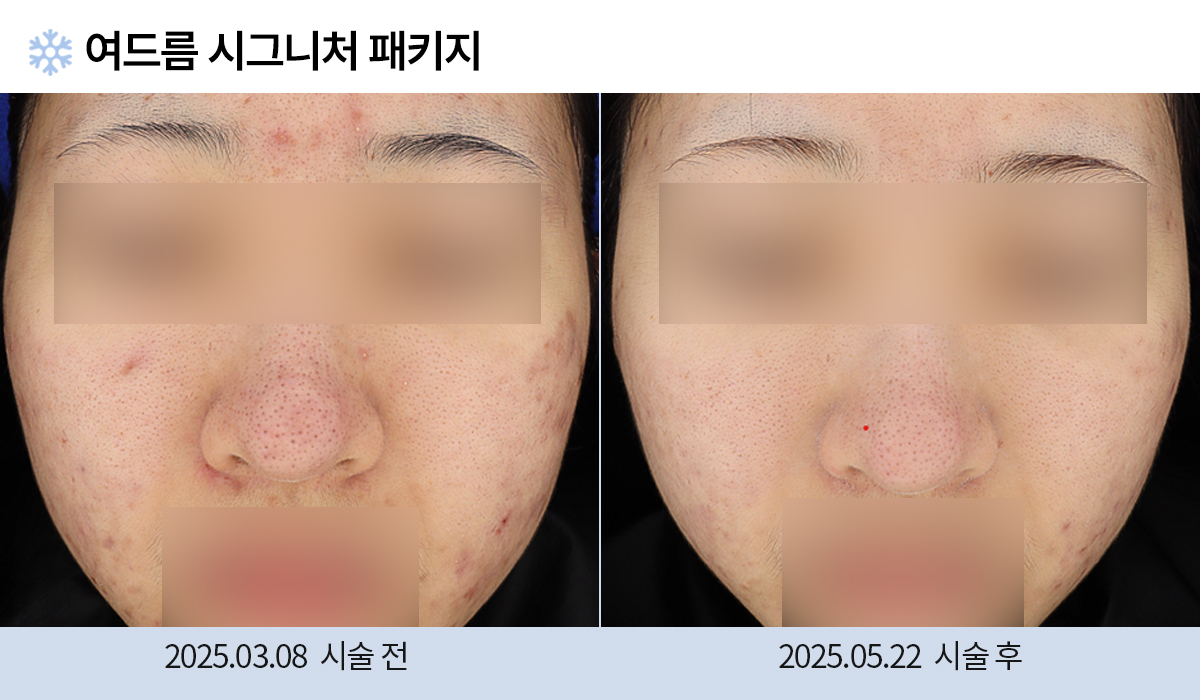 여드름/붉은자국/홍조 이미지