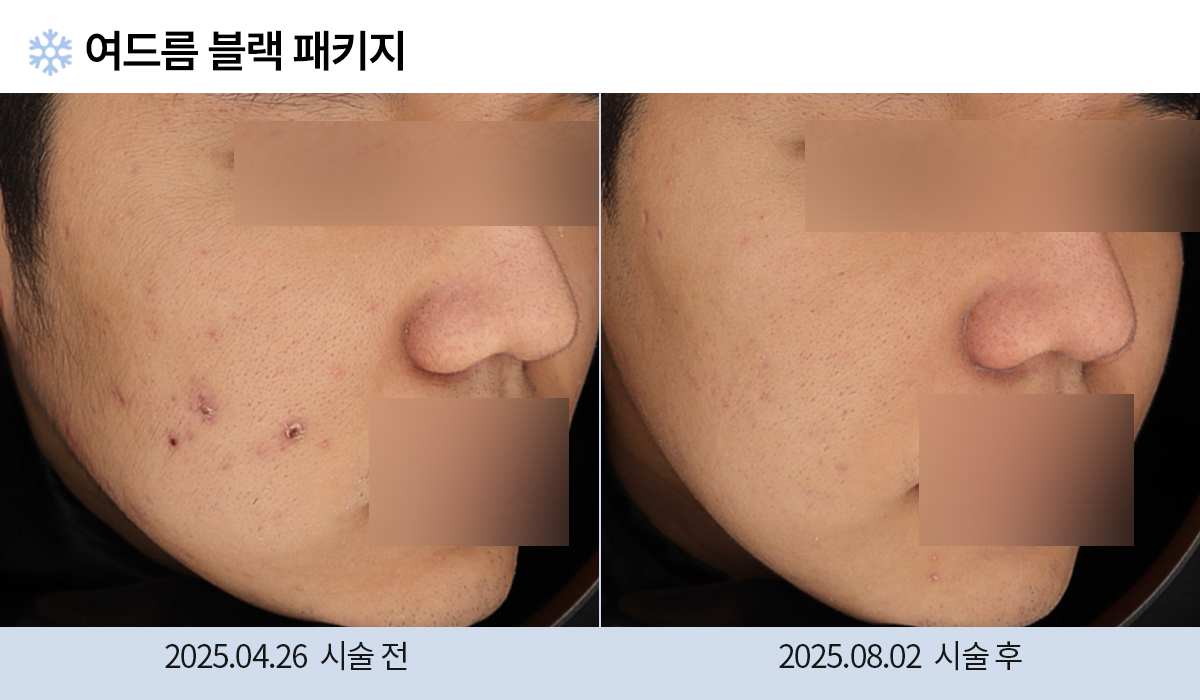 여드름/붉은자국/홍조 이미지