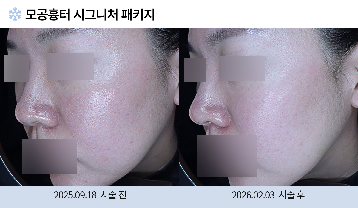 모공/주름/흉터 전후 작업 이미지
