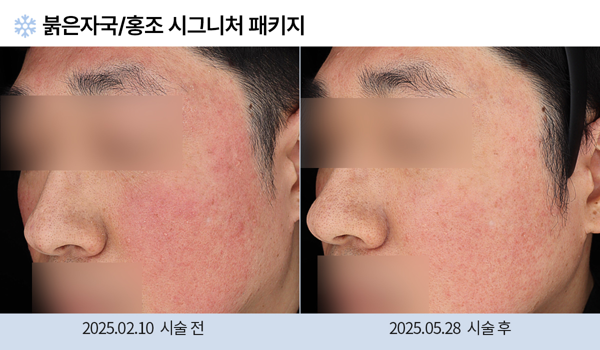 여드름/붉은자국/홍조 이미지
