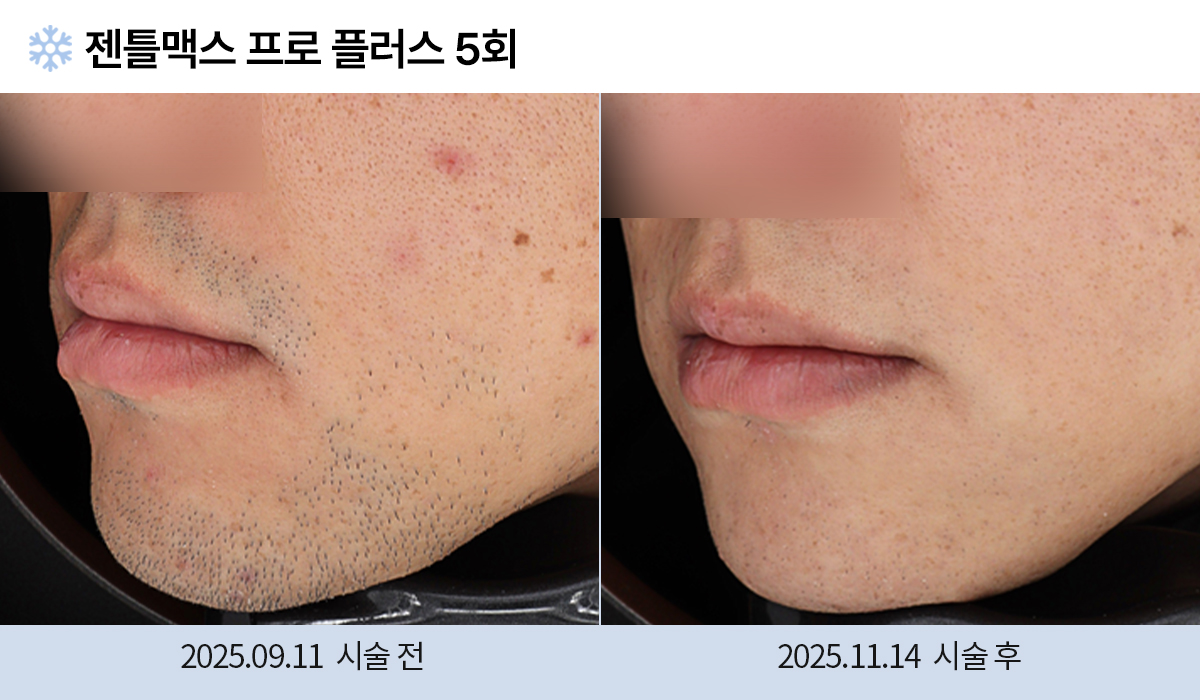 레이저 제모 전후 작업 이미지