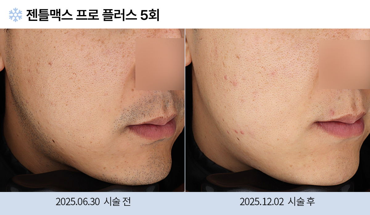 레이저 제모 전후 작업 이미지