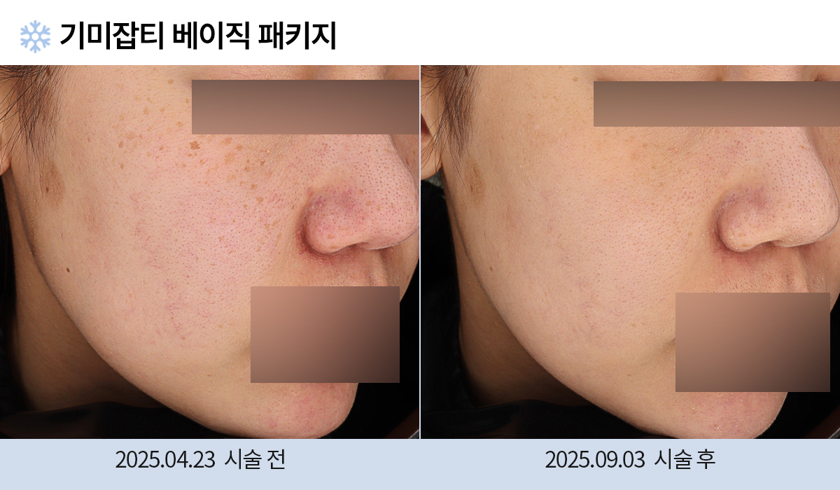 기미/주근깨/흑자 이미지