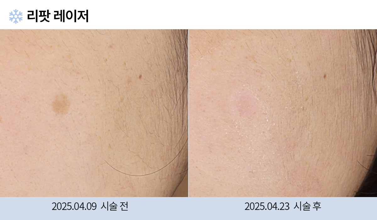 기미/주근깨/흑자 이미지