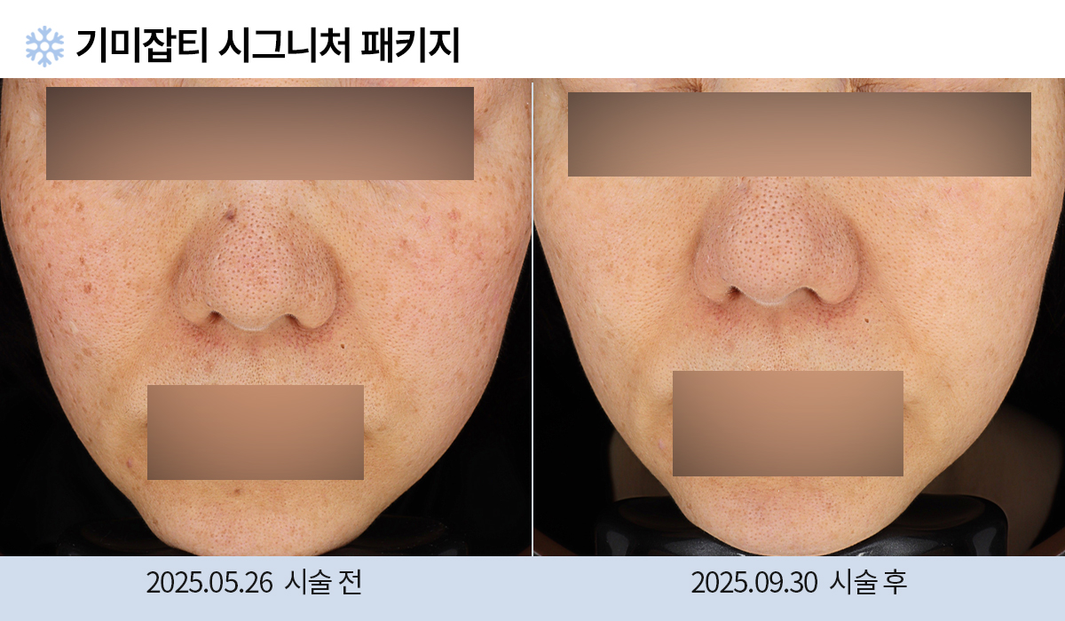 기미/주근깨/흑자 이미지