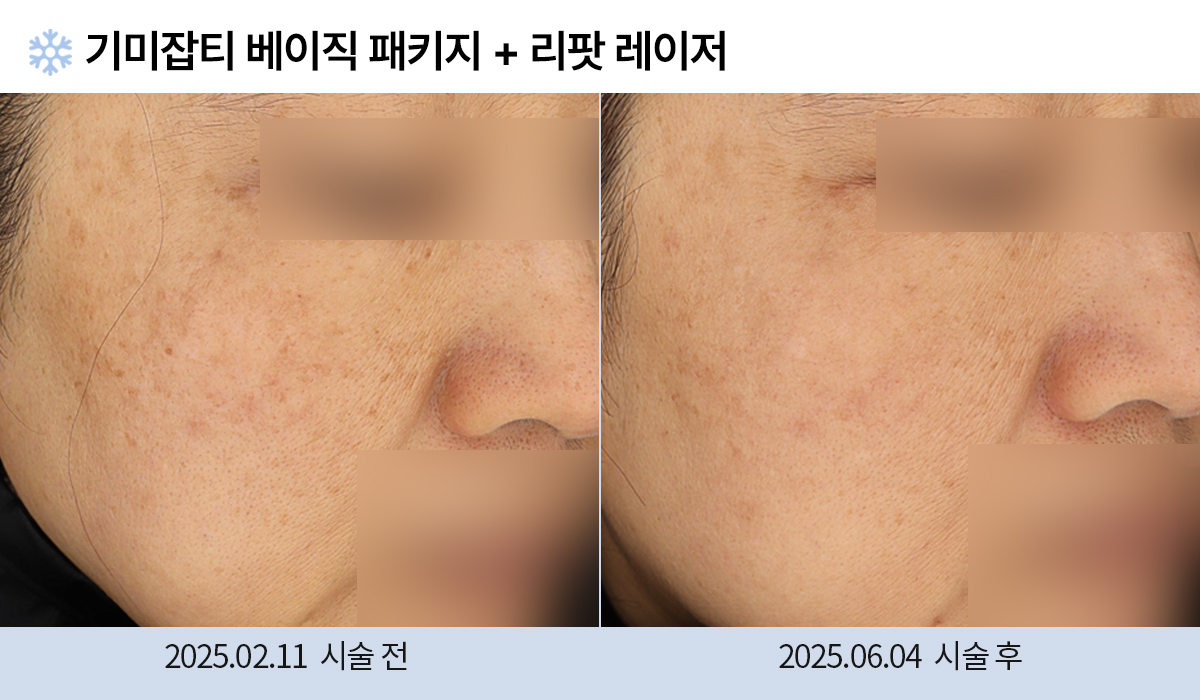 기미/주근깨/흑자 이미지