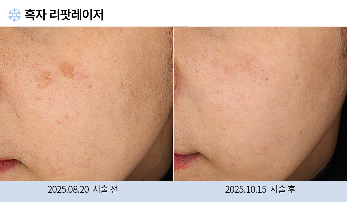 기미/주근깨/흑자 이미지