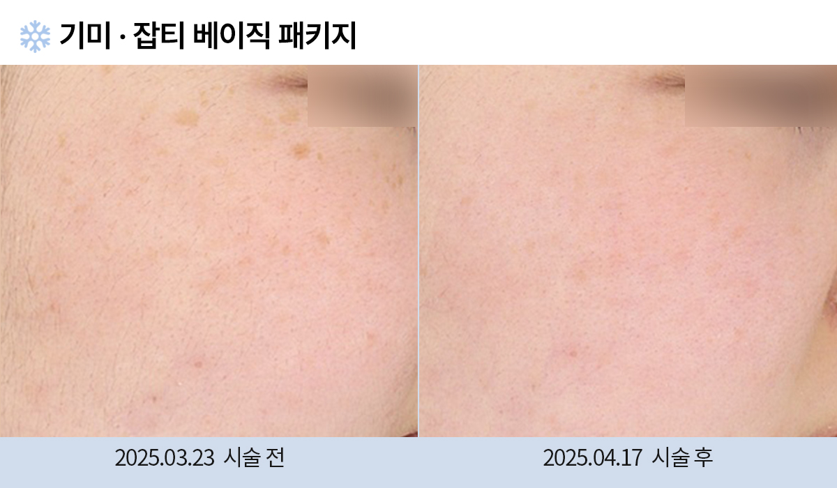 노원피부과진료 | 스노우의원 노원점, 노원보톡스, 노원여드름