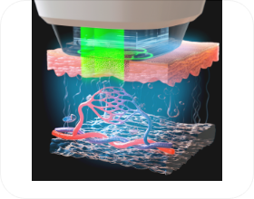 레이저 출력 제어 및 조사 이미지