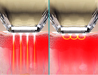 모노폴라, 바이폴라 2가지 방식
