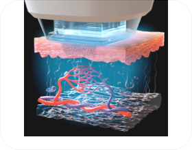타깃 시술 부위 과냉각