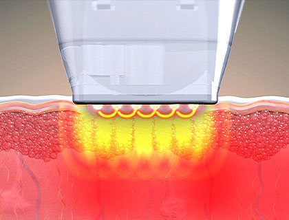 포텐자 레이저 팁이 피부를 문지르는 모습