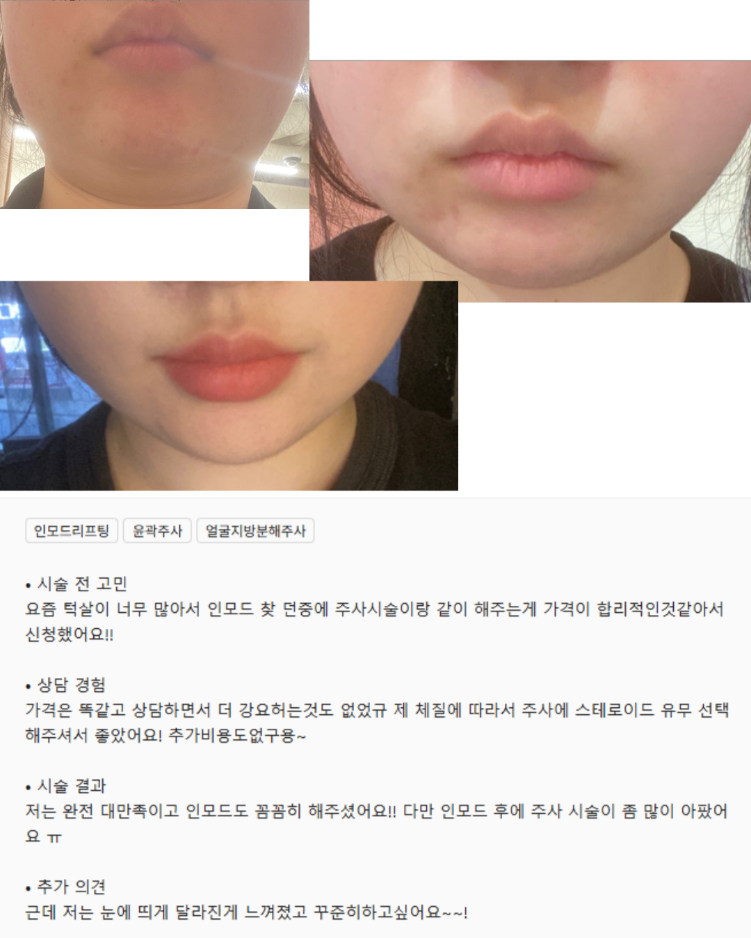 고객님] 인모드+뷰티핏주사 시술후기 : 뷰티블라썸의원 beautyblossom