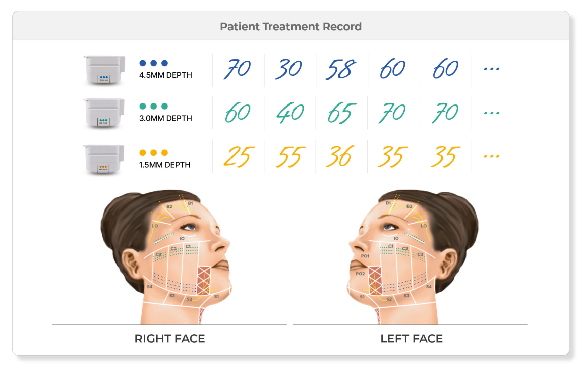 울쎄라피 프라임 시술 라인 예시