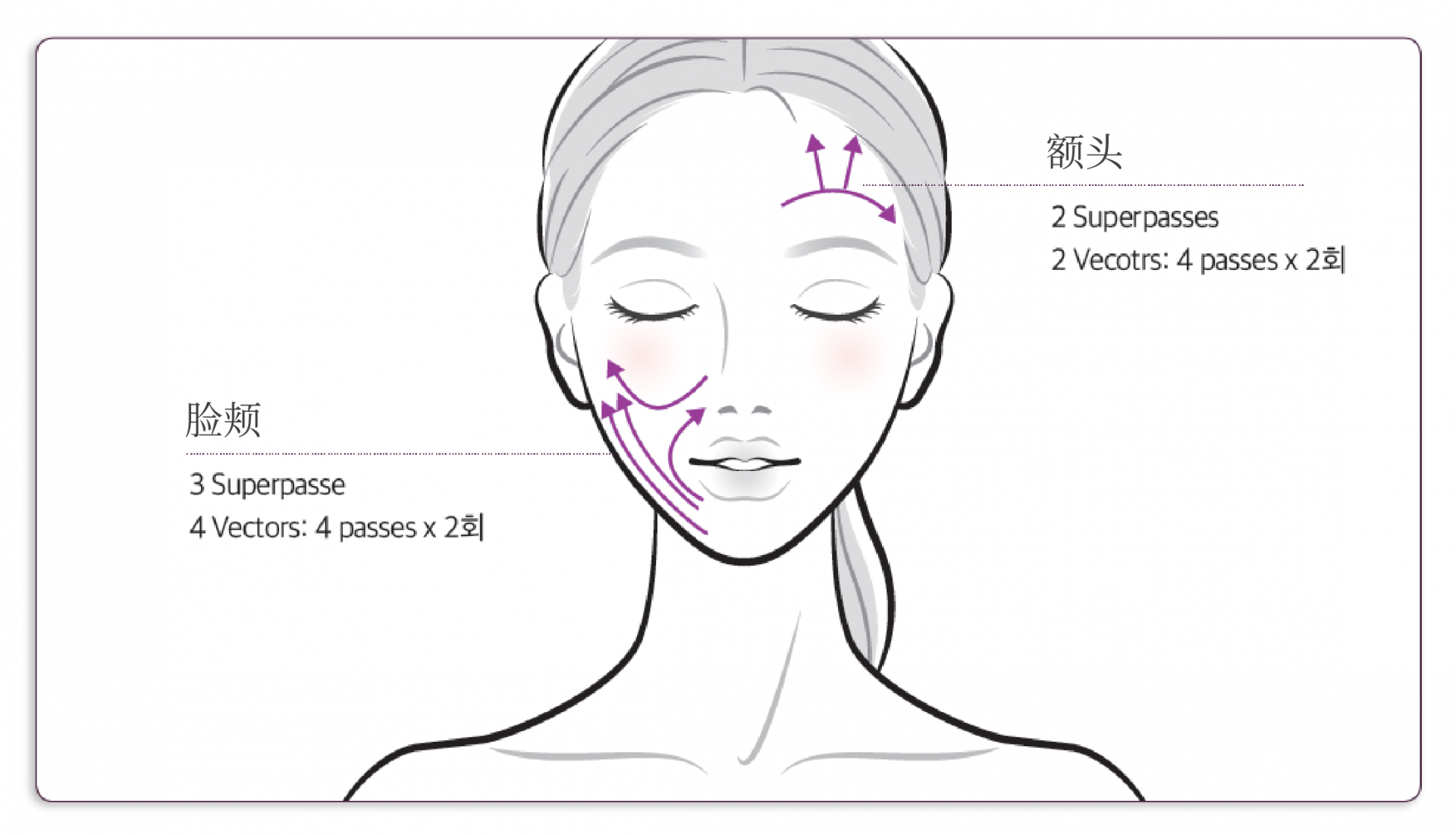 Thermage FLX 治疗部位图示