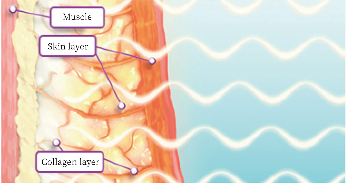 RF Energy Delivery Phase