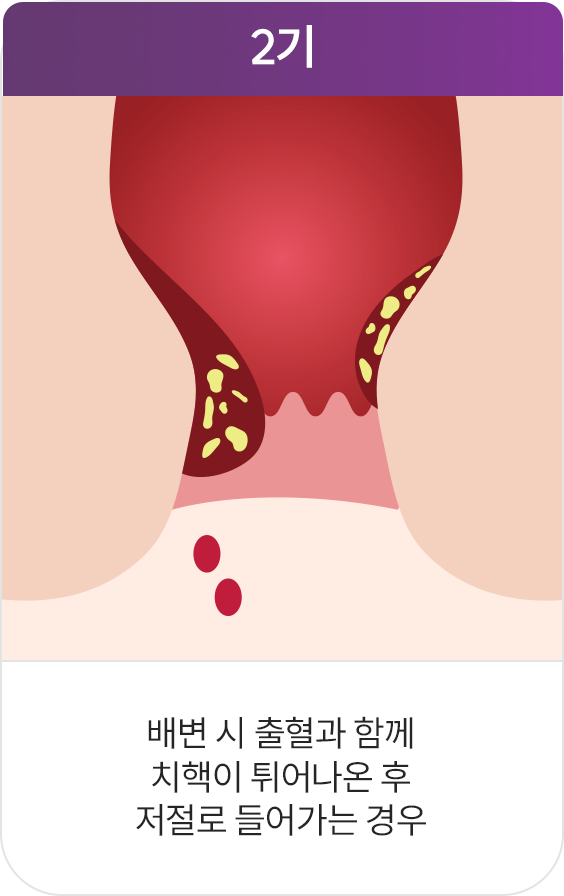 아름다운항외과 치핵
