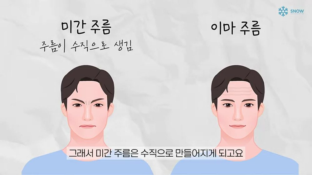천안 피부과 주름 보톡스 미간 세로 주름과 이마 가로 주름