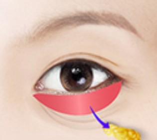 디자인 부위 절개
