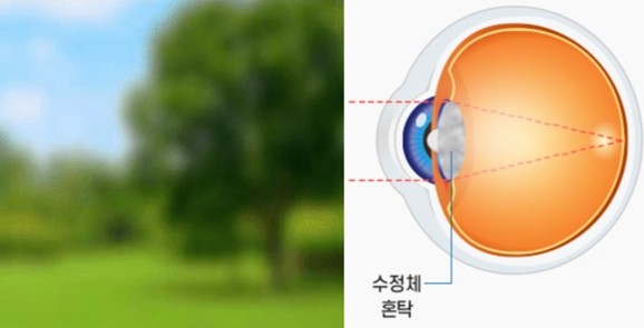 백내장 시야