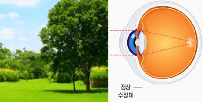 정상 시야
