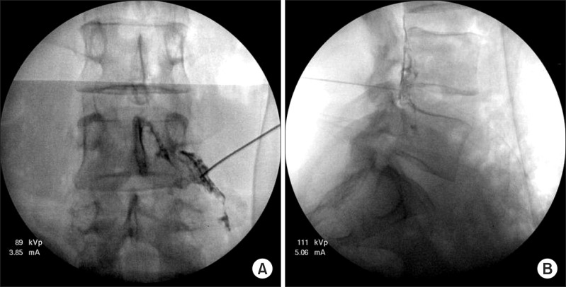 조영제주입 후 앞쪽 경막외강 확인